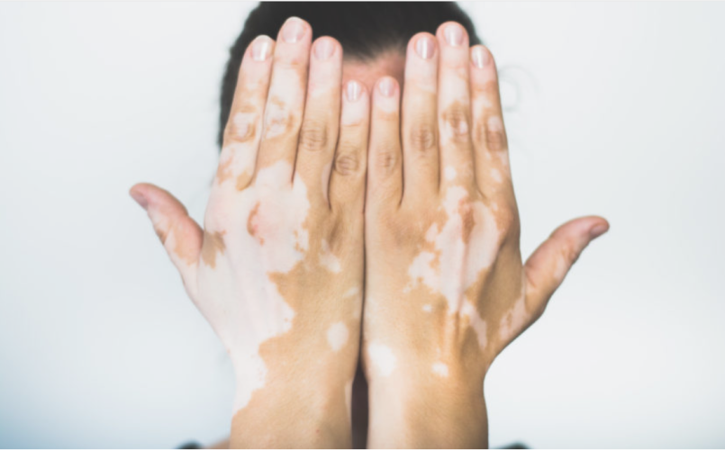 Mutuelle Mieux-Etre fait le point sur les traitements adaptés du vitiligo